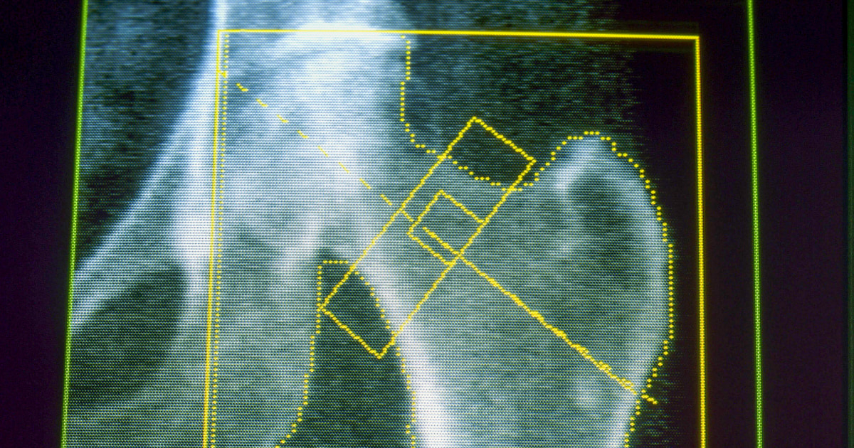 GLP-1s would possibly presumably also lengthen chance of osteoporosis and gout, new research finds GLP-1s would possibly presumably also lengthen chance of osteoporosis and gout, new research finds