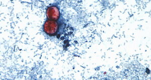 Michigan experiences first 2 US deaths in cyclospora outbreak Michigan experiences first 2 US deaths in cyclospora outbreak