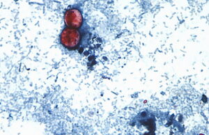Michigan experiences first 2 US deaths in cyclospora outbreak Michigan experiences first 2 US deaths in cyclospora outbreak