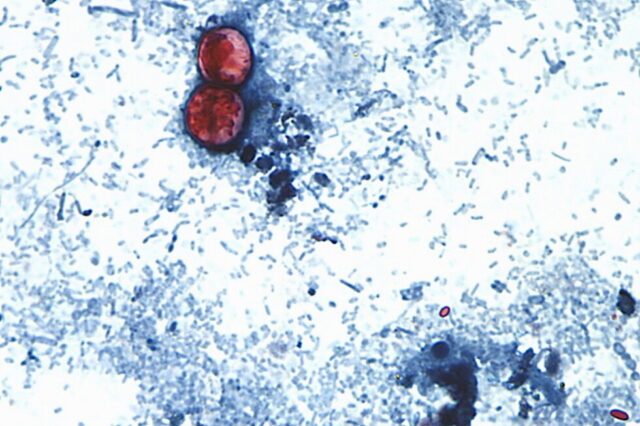 michigan-experiences-first-2-us-deaths-in-cyclospora-outbreak.jpg Michigan experiences first 2 US deaths in cyclospora outbreak